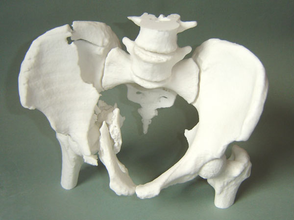 3D-printing-medical-model-pelvic